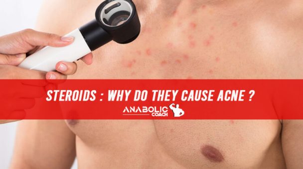 Steroids And Acne Why Do They Cause Acne Anabolic Coach